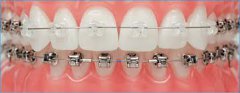 陶瓷牙齿矫正器矫正牙齿怎么样？