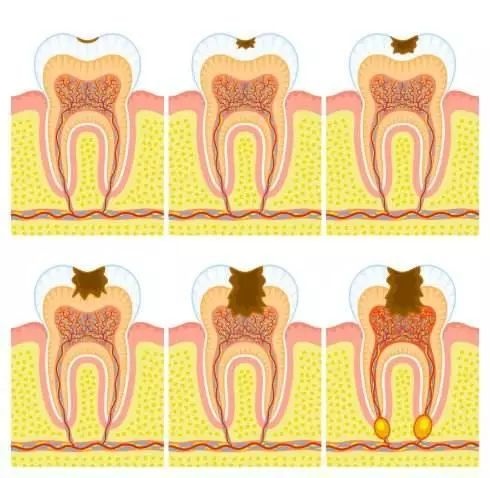 牙齿疼能做根管治疗吗